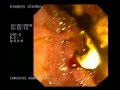 Gallstones In Common Bile Duct - ERCP Gallstones In Common Bile Duct - ERCP