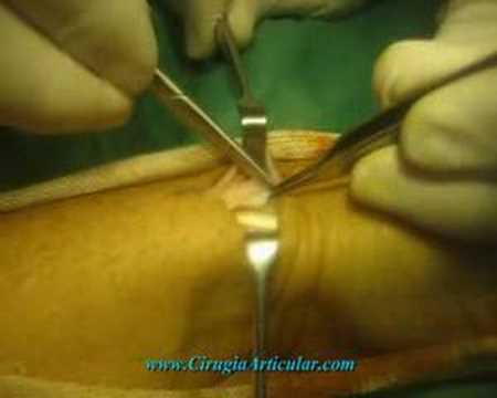 Tendinitis de Quervain cirugia. Length: 2:16; Rating Average: 4.5' max='5' 