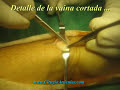 Tendinitis de Quervain cirugia