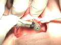 Mini Dental Implants - Mini Implant Dentures in 10 minutes! Mini Dental Implants - Mini Implant Dentures in 10 minutes!