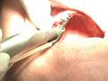 Mini Dental Implants - Mini Implant Dentures in 10 minutes!
