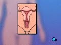 PreOp® Patient Education Hysterectomy Removal of the Uterus