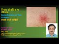 Treatment For Liver Cirrhosis