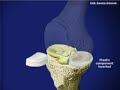 artroprotesizzazione monocompartimentale