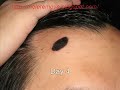 Natural Mole Removal - How to Cure Ugly Moles Naturally