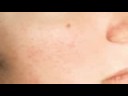 Rosacea treatment in our Sarasota Dermatology office