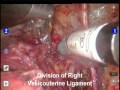 Robotic Radical Hysterectomy for Cervical Cancer