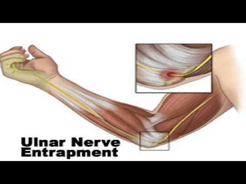 how to relieve arm muscle pain