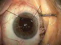 Cataract Surgery: IFIS using Iris Retractors, Pt. 2 of 2