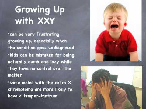 how to know if i have klinefelter's syndrome