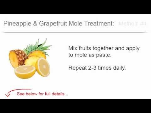 how to remove moles