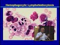 An Overview of Histiocytosis Pt 3 of 4