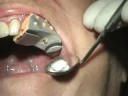 Immediate single implant tooth