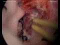 Recurrent 4th ventricle ependymoma - Suboccipital approach