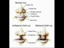 Etiology of Cleft lip & Palate, Clinical Pediatric Dentistry Etiology of Cleft lip & Palate, Clinical Pediatric Dentistry