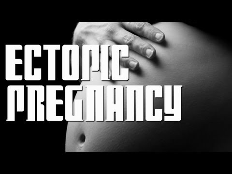 how to avoid ectopic pregnancy