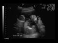 Identical Twins Ultrasound - 15 weeks 3 days
