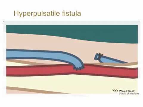 how to examine av fistula
