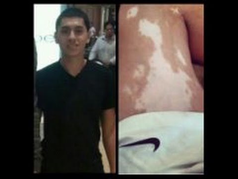 how to treat vitiligo