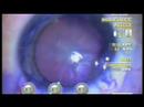 MICS, Vision Blue &amp; Tecnis Multifocal IOL