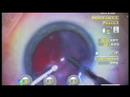 MICS, Vision Blue & Tecnis Multifocal IOL MICS, Vision Blue & Tecnis Multifocal IOL