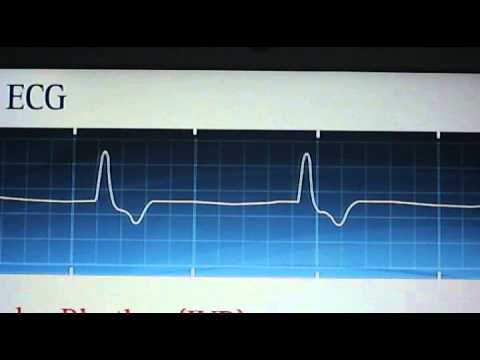 how to treat idioventricular rhythm