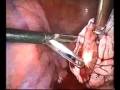 laparoscopic management of ovarian cyst