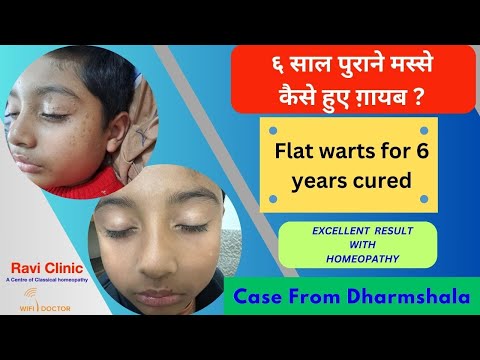 Flat warts for 6 years and Bed Wetting got cured