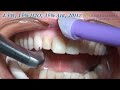 Veneer Removal Veneer Removal