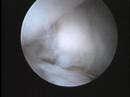 Artroscopia rodilla CR Andar