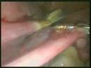Lapararoscopic Supracervical Hysterectomy