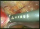 Lapararoscopic Supracervical Hysterectomy