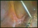 Lapararoscopic Supracervical Hysterectomy
