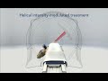 TomoTherapy - Revolutionary Radiation Therapy