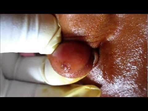 how to drain epidermal cyst