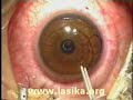 Lasik Eye Surgery ????? ???? ?????