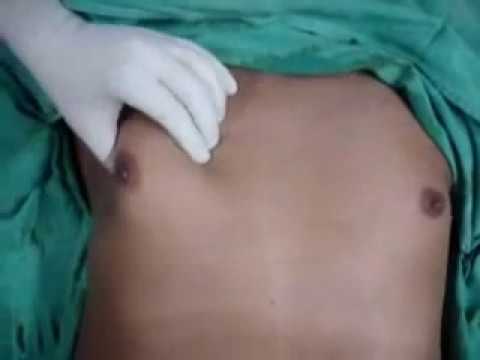 how to remove gyno yourself