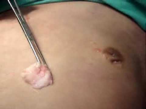 how to reduce nipple size