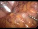 Laparoscopic TAC for FAP