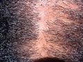 Click here to watch this video Onion and Garlic Hair Regrowth Treatment