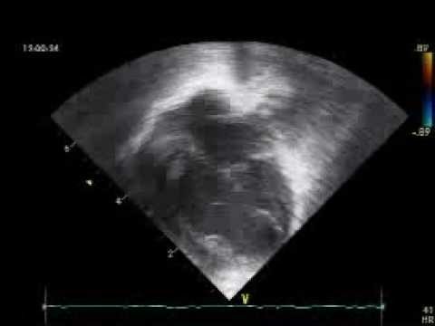 how to measure fetal heart rate in m-mode