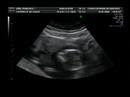 Ecografia 15 Semanas y 5 Dias Ecografia 15 Semanas y 5 Dias
