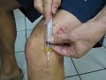 Ganglion Cyst Draining