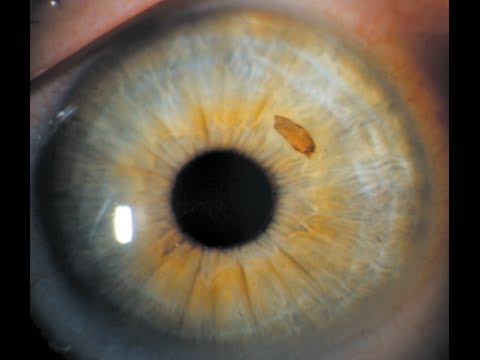 how to patch eye for corneal abrasion