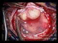 Craniotomy Neurosurgery Meningioma Removal