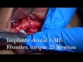Bone Split anterior, 4 implantes