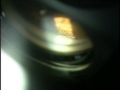 Demonstration of the opening of a cyclodialysis glaucoma operation by Scott Geller MD