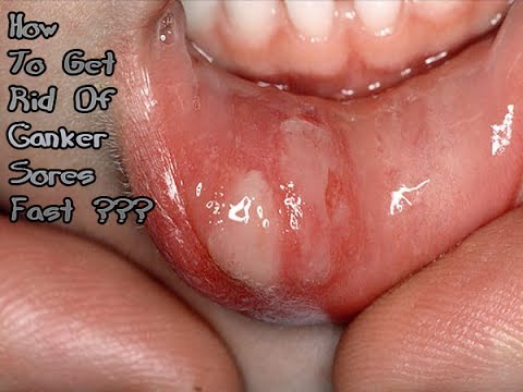 how to cure ulcer fast