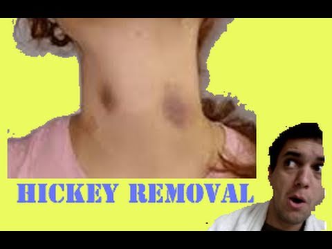 how to get rid rid of a hickey