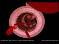 3D Stent Implant Animation